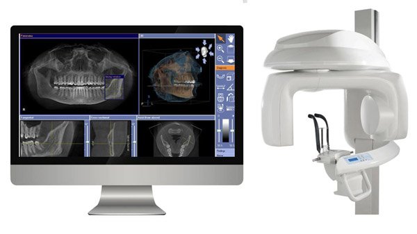 tomograf dentar pentru implant